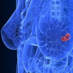 a computer model of a tumor in a breast